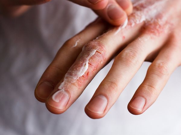 Crème hydratante pour mains contre les crevasses - Parapharmadirect